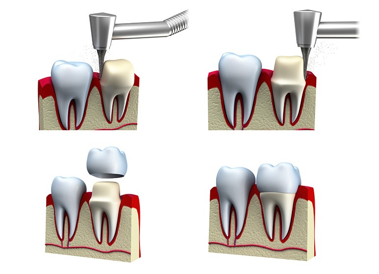 Dental Crowns | Nuera Dental Center | General & Family Dentist | Downtown Calgary