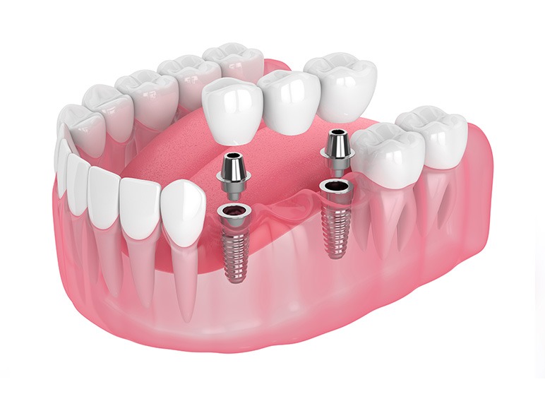 Dental Implants | Nuera Dental Center | General & Family Dentist | Downtown Calgary