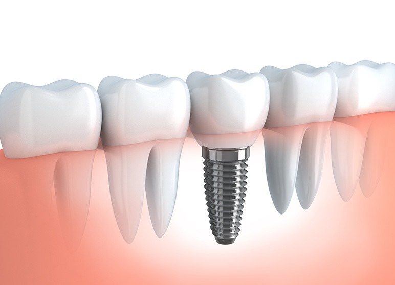 Dental Implants | Nuera Dental Center | General & Family Dentist | Downtown Calgary