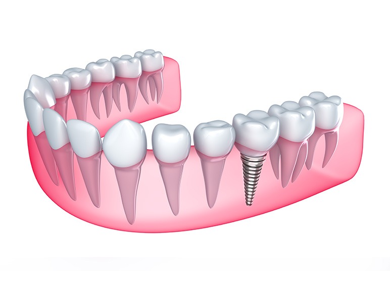 Dental Implants | Nuera Dental Center | General & Family Dentist | Downtown Calgary