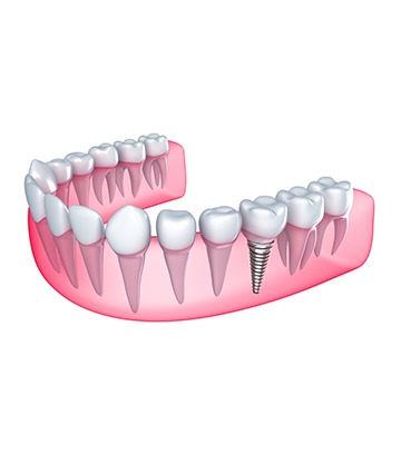 Dental Implants | Nuera Dental Center | General & Family Dentist | Downtown Calgary