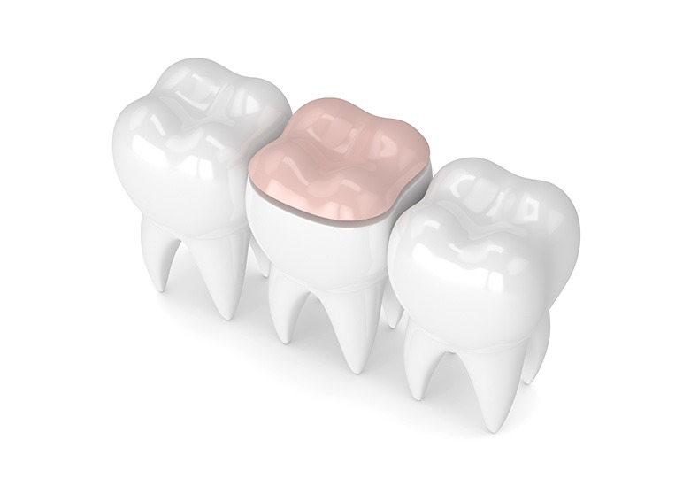 Dental Inlays & Onlays | Nuera Dental Center | General & Family Dentist | Downtown Calgary