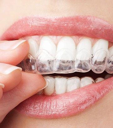 Invisalign® | Nuera Dental Center | General & Family Dentist | Downtown Calgary
