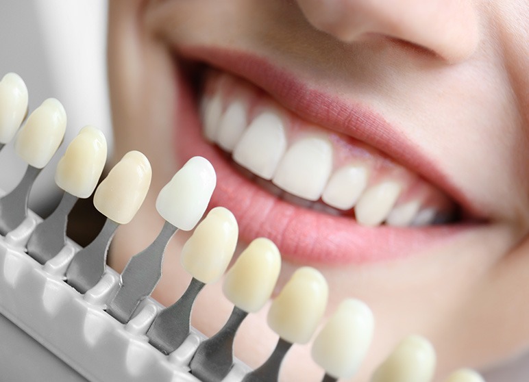 Porcelain Veneers | Nuera Dental Center | General & Family Dentist | Downtown Calgary