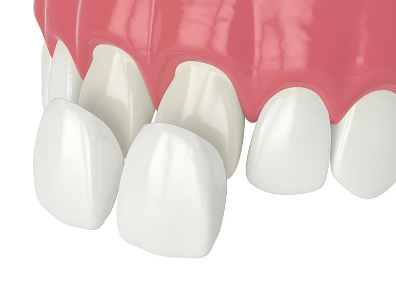 Porcelain Veneers | Nuera Dental Center | General & Family Dentist | Downtown Calgary