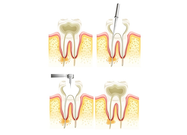 Root Canal Therapy | Nuera Dental Center | General & Family Dentist | Downtown Calgary