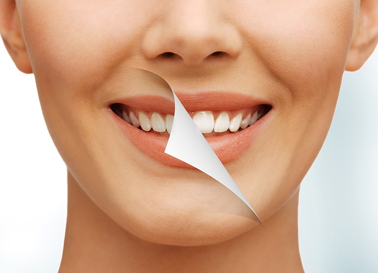 Teeth Whitening | Nuera Dental Center | General & Family Dentist | Downtown Calgary