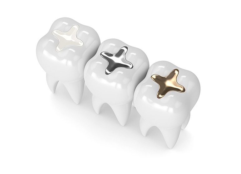 Tooth Coloured Fillings | Nuera Dental Center | General & Family Dentist | Downtown Calgary